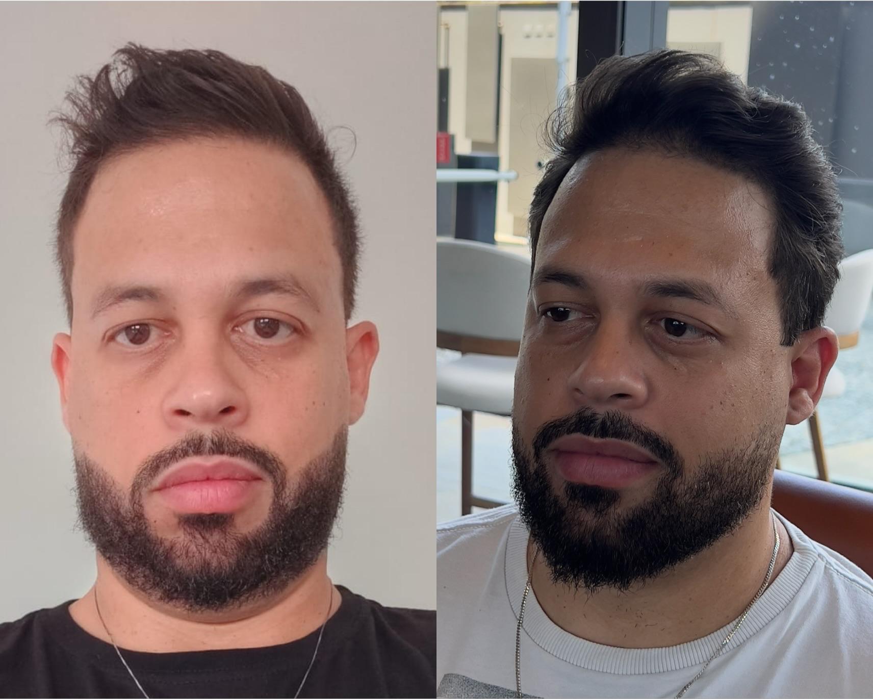 Antes e Depois - Cliente 11
